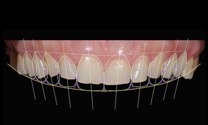 analyse-du-sourire-dsd-dental-smile-design